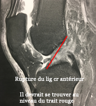 Rupture du LLI du genou sous IRM